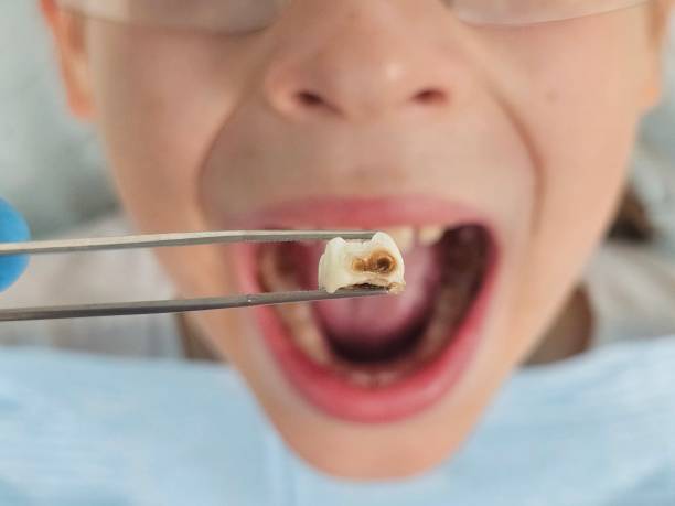Best Broken or Cracked Tooth Emergency Dentist in Glenshaw, PA